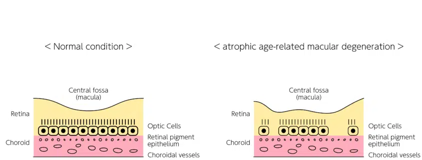 Infographic depicting atrophic age-related macular degeneration