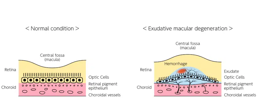 Infographic depicting exudative macular degeneration