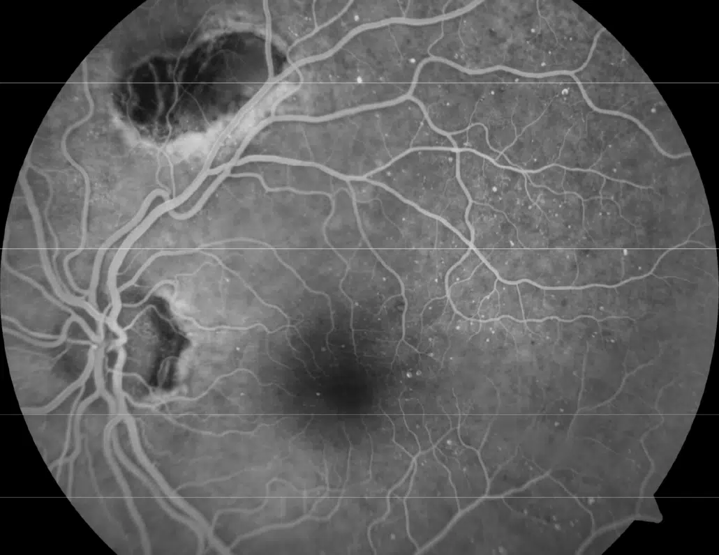 Diabetic Macular Edema Example