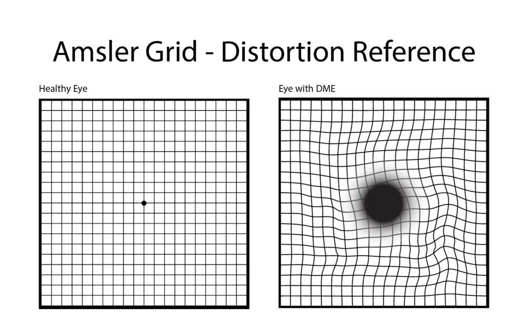 Amsler Grid - Distortion Reference