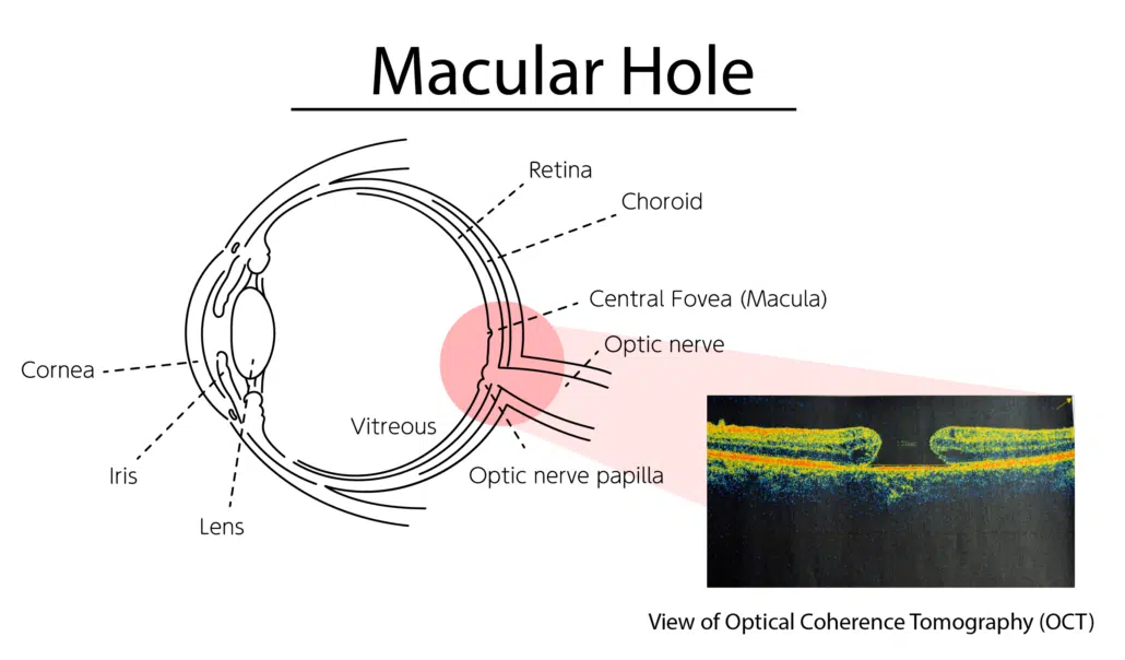 Macular Hole Diagram