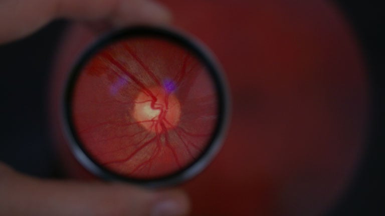 Close up image of what a retinal specialist may see when conducting a comprehensive eye exam for a vein occlusion.