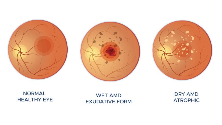 Illustrations showing the 3 main stages of macular degeneration.