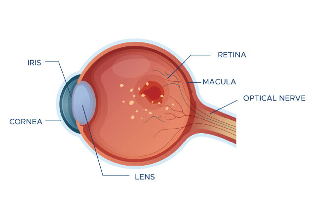 Eye diagram example of the stages of Age-related macular degeneration.