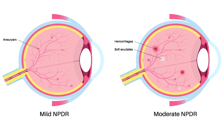 Image of mild to moderate Diabetic retinopathy.