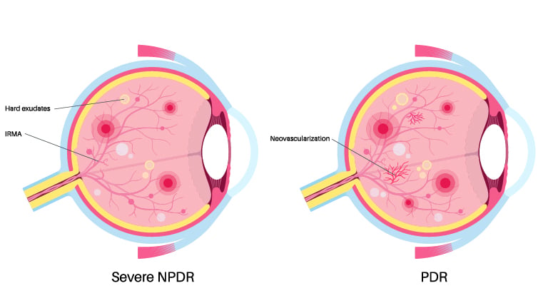 Image of proliferative diabetic retinopathy progression.